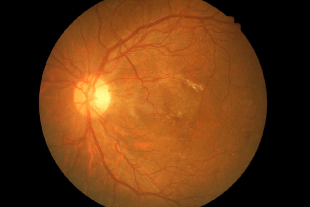 Retinal Neovascularization: Mechanisms and Treatment Approaches